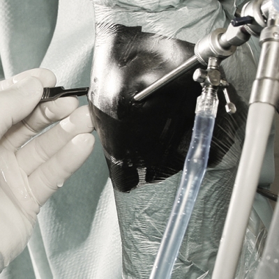 Arthroscopy