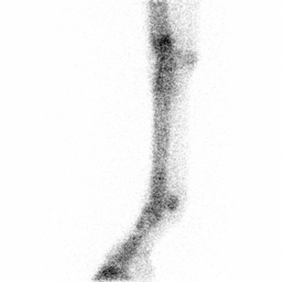 Scintigraphy