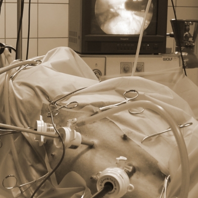 Laparoscopy